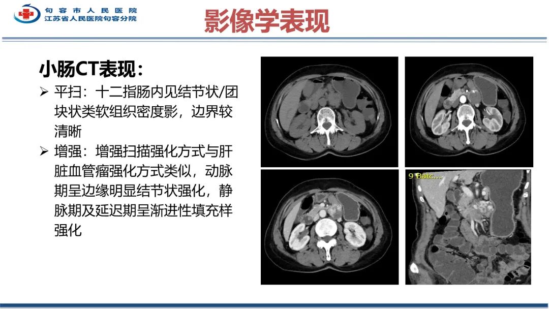 影像PPT - 【PPT】十二指肠血管瘤-27