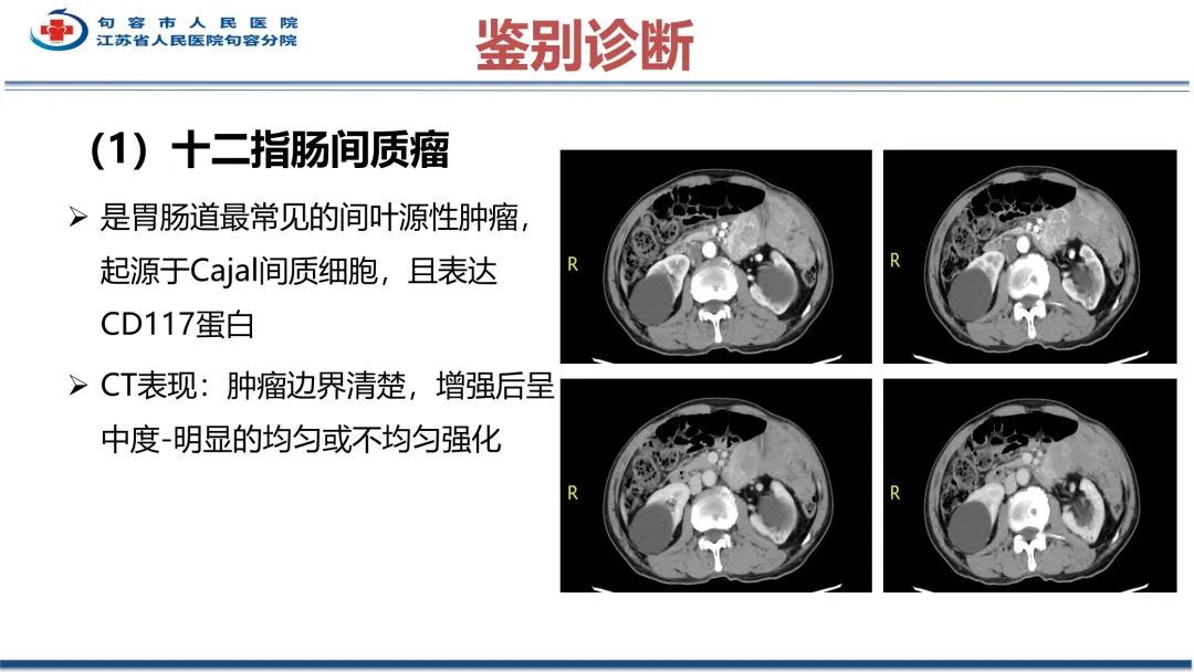 影像PPT - 【PPT】十二指肠血管瘤-30