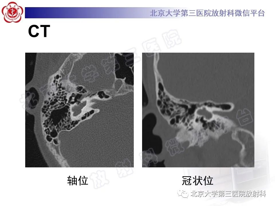影像PPT - 【PPT】先天性内耳畸形-3