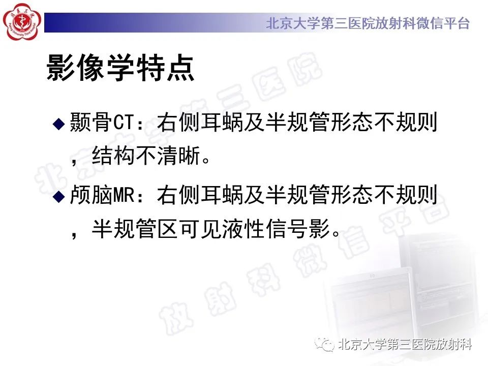影像PPT - 【PPT】先天性内耳畸形-5