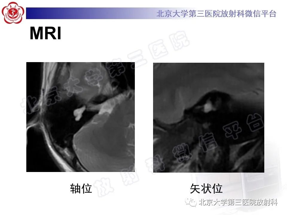 影像PPT - 【PPT】先天性内耳畸形-4