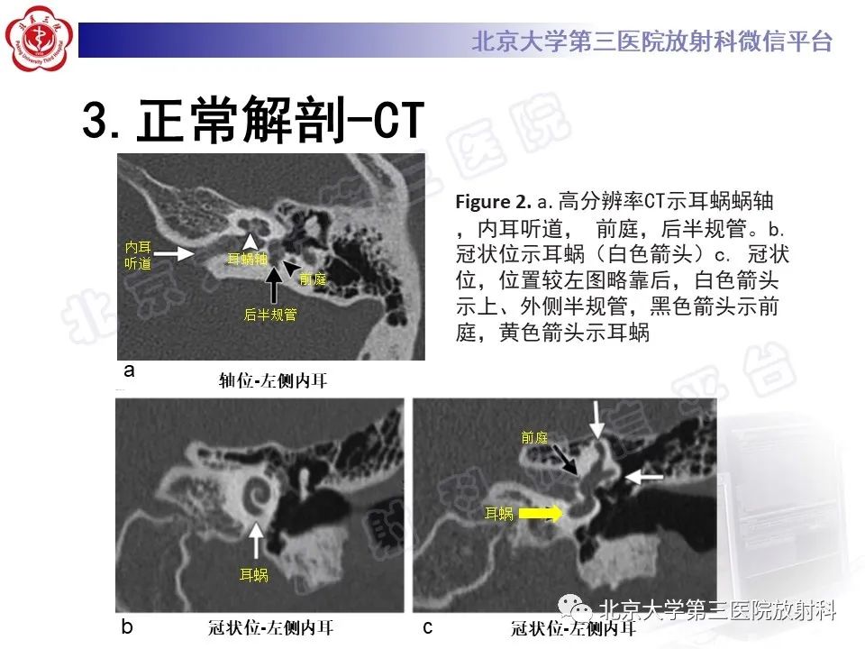 影像PPT - 【PPT】先天性内耳畸形-11
