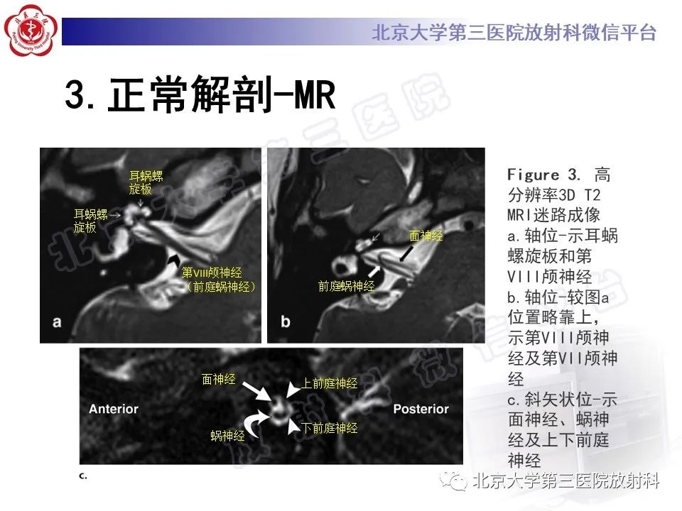 影像PPT - 【PPT】先天性内耳畸形-12