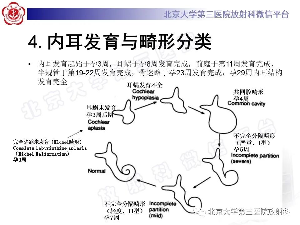 影像PPT - 【PPT】先天性内耳畸形-13