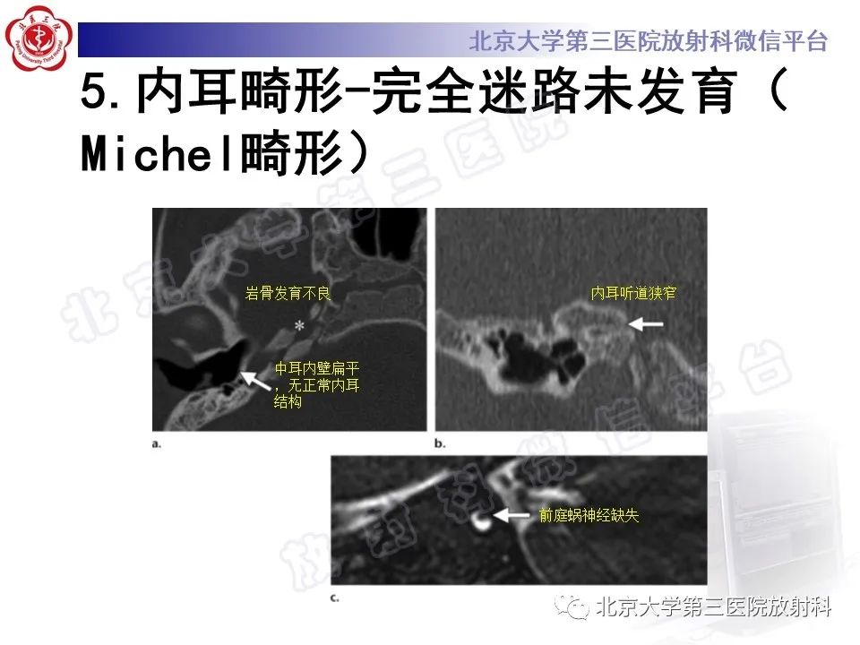 影像PPT - 【PPT】先天性内耳畸形-15