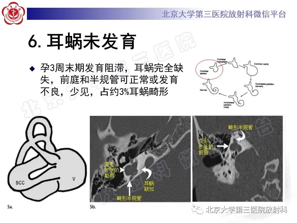 影像PPT - 【PPT】先天性内耳畸形-16