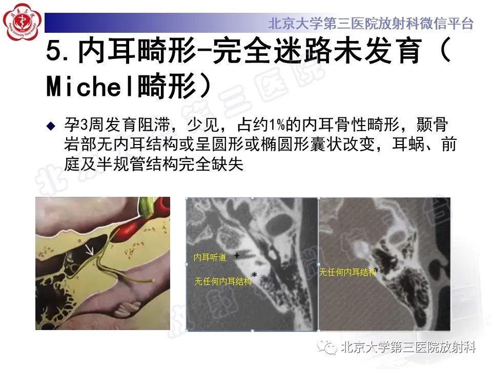 影像PPT - 【PPT】先天性内耳畸形-14