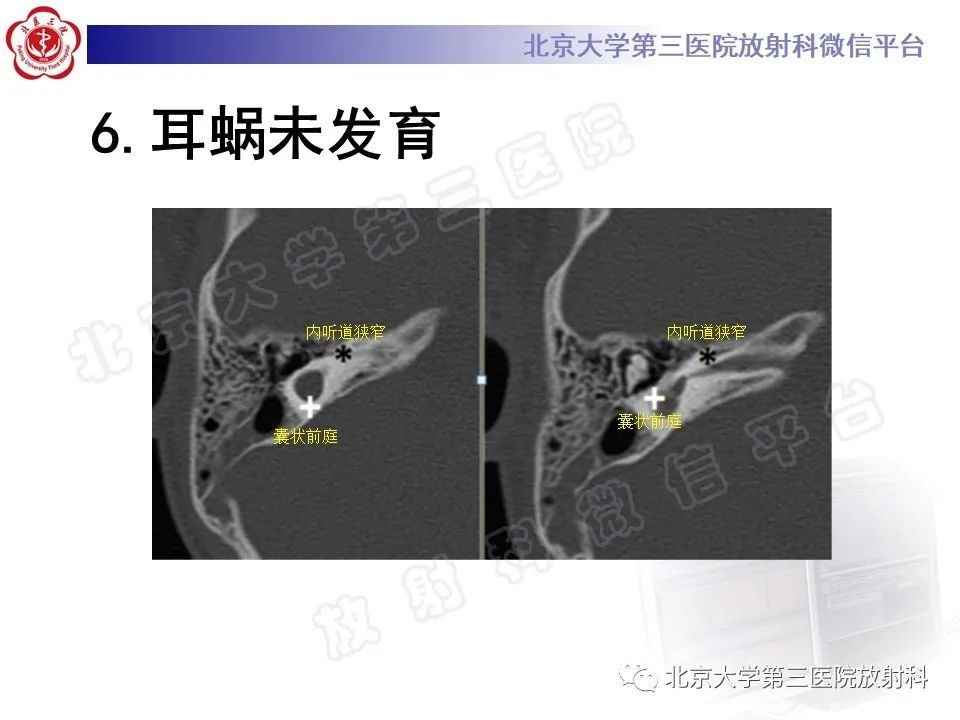 影像PPT - 【PPT】先天性内耳畸形-17
