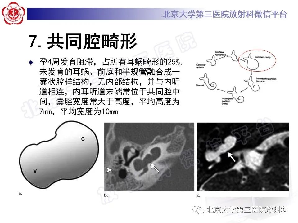 影像PPT - 【PPT】先天性内耳畸形-18
