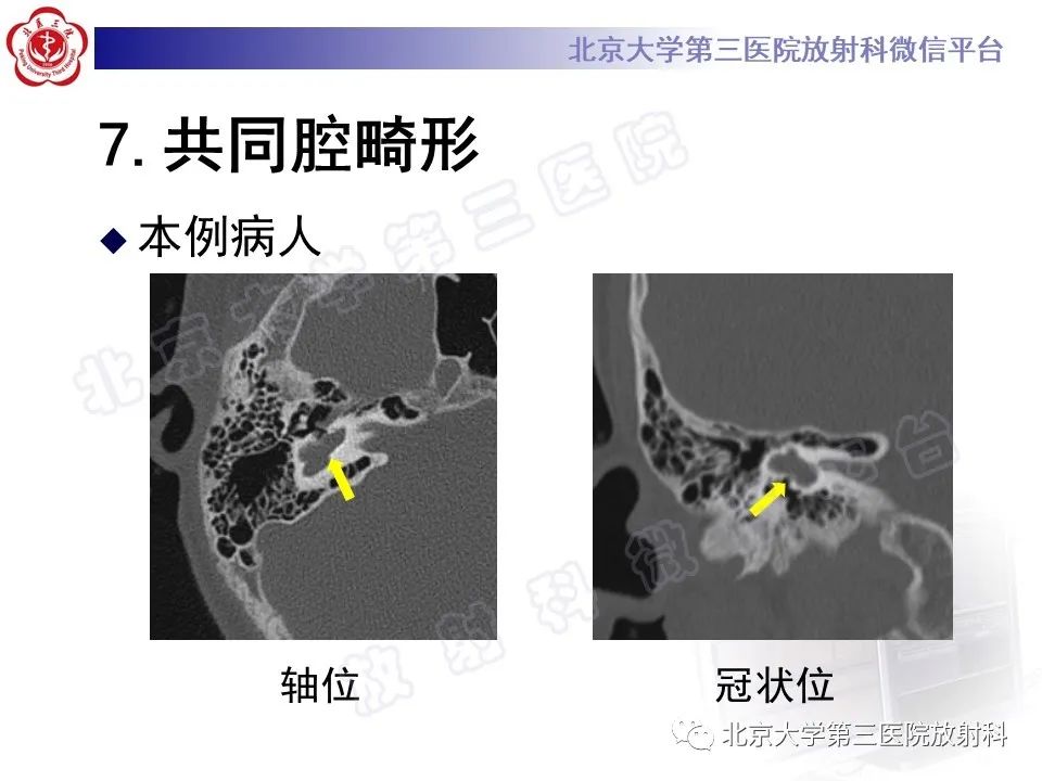 影像PPT - 【PPT】先天性内耳畸形-20