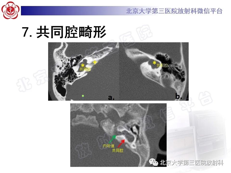 影像PPT - 【PPT】先天性内耳畸形-19