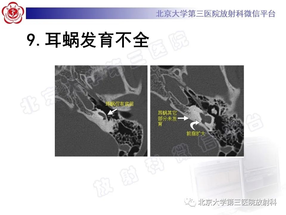 影像PPT - 【PPT】先天性内耳畸形-24