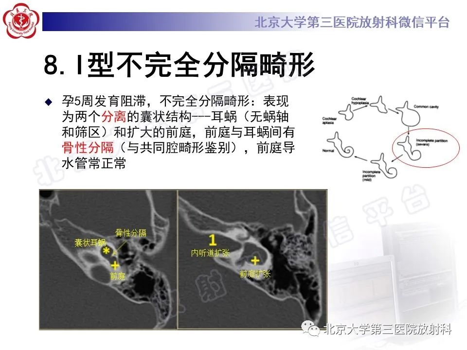 影像PPT - 【PPT】先天性内耳畸形-21