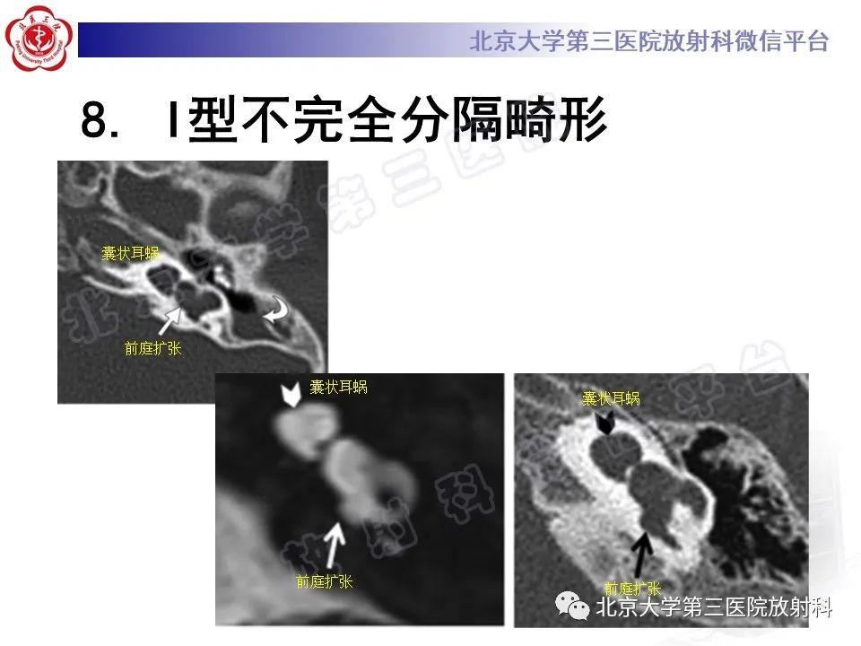 影像PPT - 【PPT】先天性内耳畸形-22