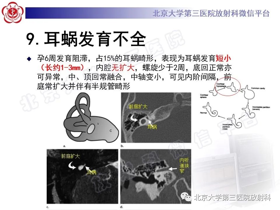 影像PPT - 【PPT】先天性内耳畸形-23