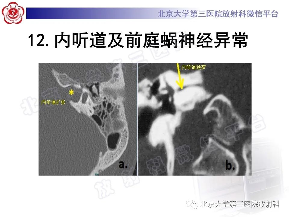 影像PPT - 【PPT】先天性内耳畸形-32
