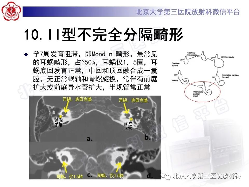 影像PPT - 【PPT】先天性内耳畸形-25