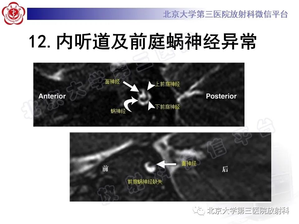 影像PPT - 【PPT】先天性内耳畸形-33