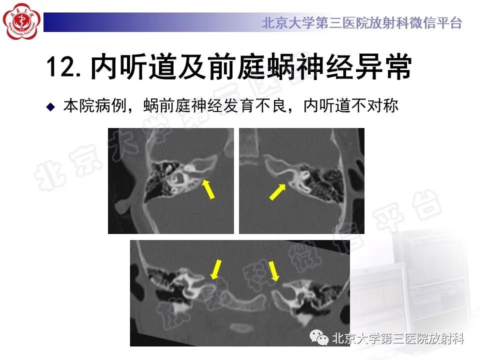 影像PPT - 【PPT】先天性内耳畸形-35