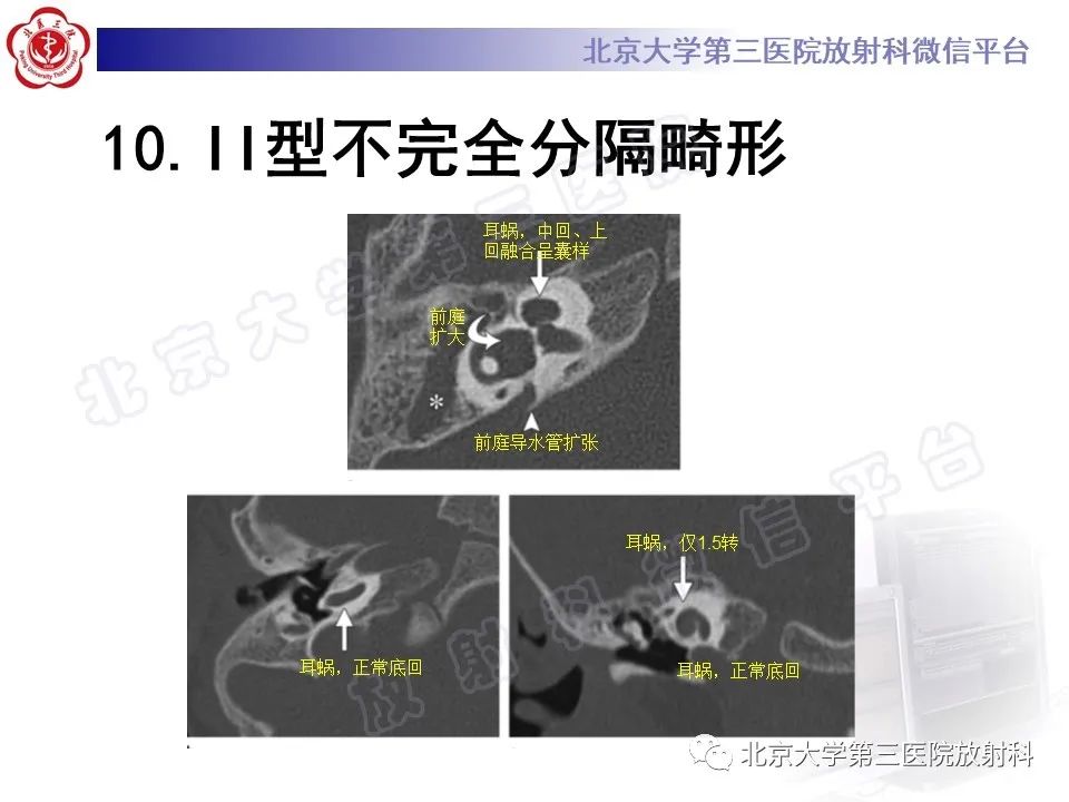 影像PPT - 【PPT】先天性内耳畸形-26