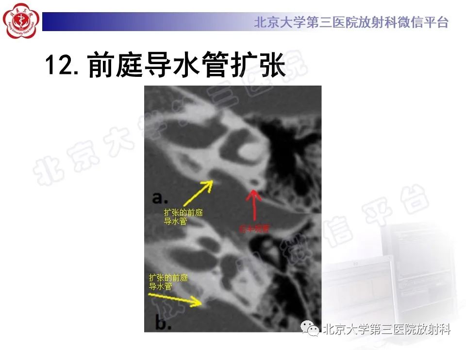 影像PPT - 【PPT】先天性内耳畸形-30
