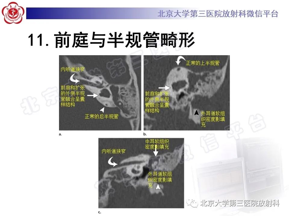 影像PPT - 【PPT】先天性内耳畸形-28