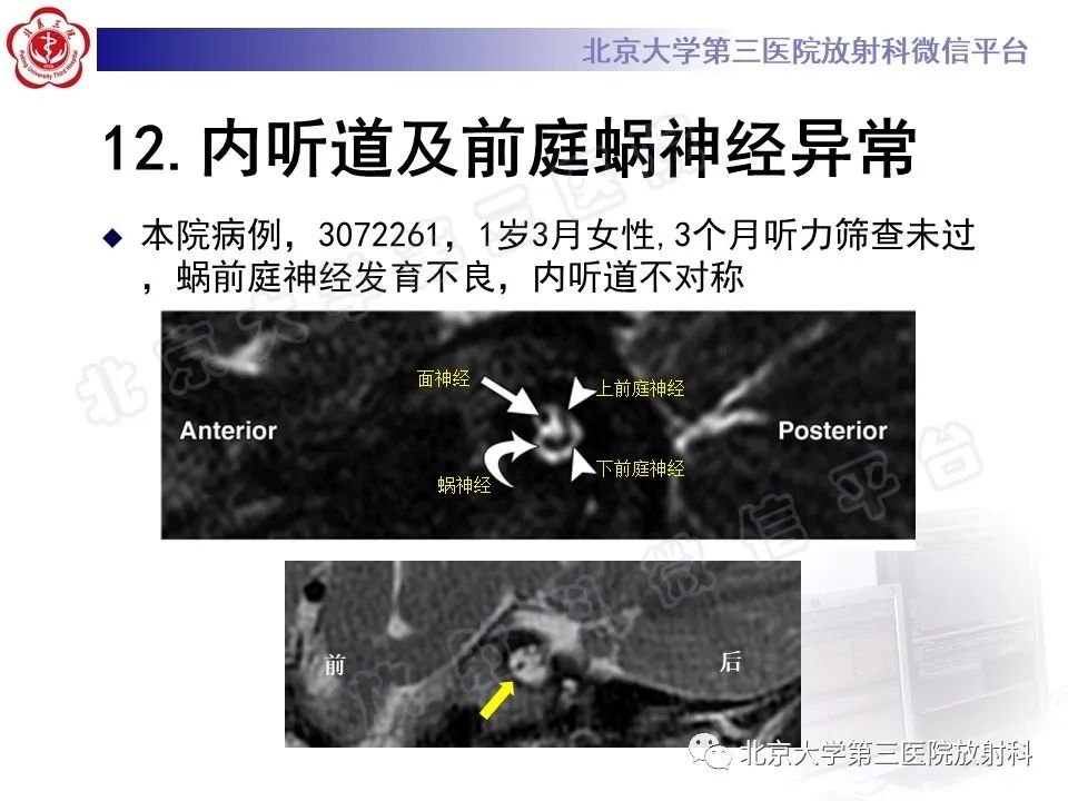 影像PPT - 【PPT】先天性内耳畸形-34