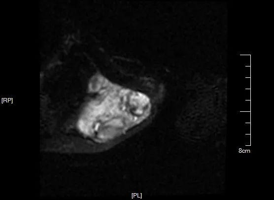 影像PPT - 【病例】黏液纤维肉瘤1例X线MR影像-7 影像PPT - 【病例】黏液纤维肉瘤1例X线MR影像-7