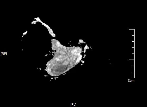 影像PPT - 【病例】黏液纤维肉瘤1例X线MR影像-8 影像PPT - 【病例】黏液纤维肉瘤1例X线MR影像-8