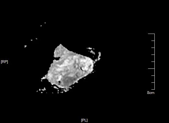 影像PPT - 【病例】黏液纤维肉瘤1例X线MR影像-10 影像PPT - 【病例】黏液纤维肉瘤1例X线MR影像-10