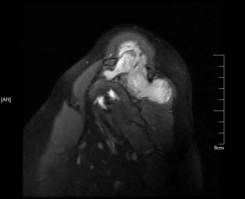 影像PPT - 【病例】黏液纤维肉瘤1例X线MR影像-6 影像PPT - 【病例】黏液纤维肉瘤1例X线MR影像-6