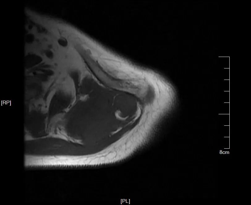 影像PPT - 【病例】黏液纤维肉瘤1例X线MR影像-2 影像PPT - 【病例】黏液纤维肉瘤1例X线MR影像-2