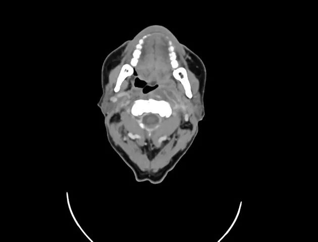 影像PPT - 【病例】黏液纤维肉瘤1例X线MR影像-14 影像PPT - 【病例】黏液纤维肉瘤1例X线MR影像-14