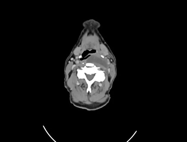 影像PPT - 【病例】黏液纤维肉瘤1例X线MR影像-15 影像PPT - 【病例】黏液纤维肉瘤1例X线MR影像-15