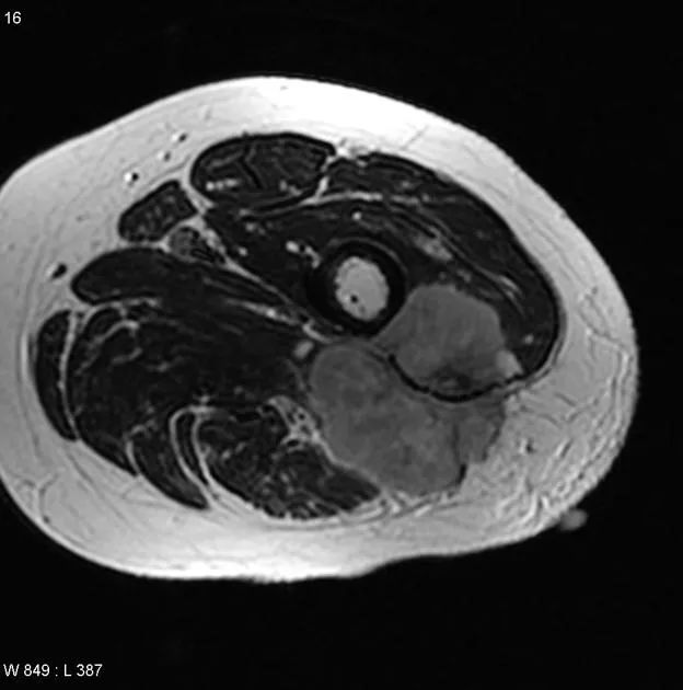 影像PPT - 【病例】黏液纤维肉瘤1例X线MR影像-31 影像PPT - 【病例】黏液纤维肉瘤1例X线MR影像-31