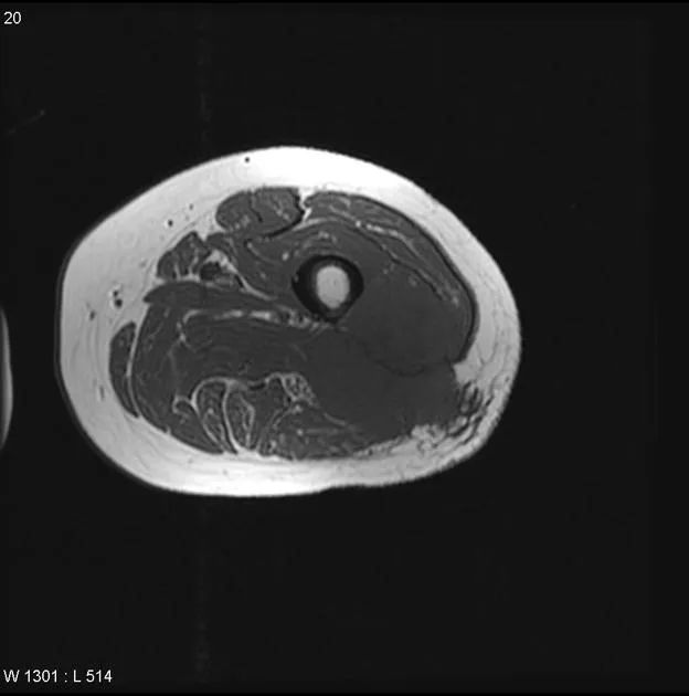 影像PPT - 【病例】黏液纤维肉瘤1例X线MR影像-30 影像PPT - 【病例】黏液纤维肉瘤1例X线MR影像-30