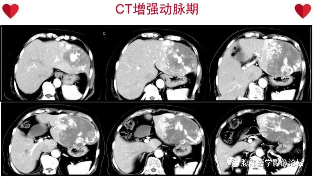 影像PPT - 【病例】肝脏血管肉瘤1例CT及MR影像解析-5