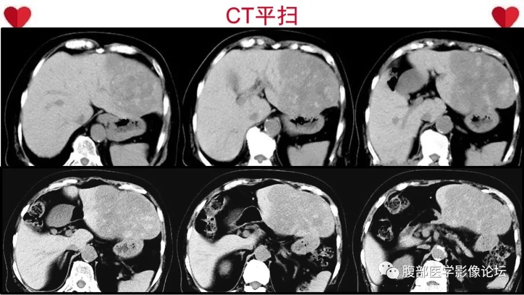 影像PPT - 【病例】肝脏血管肉瘤1例CT及MR影像解析-4