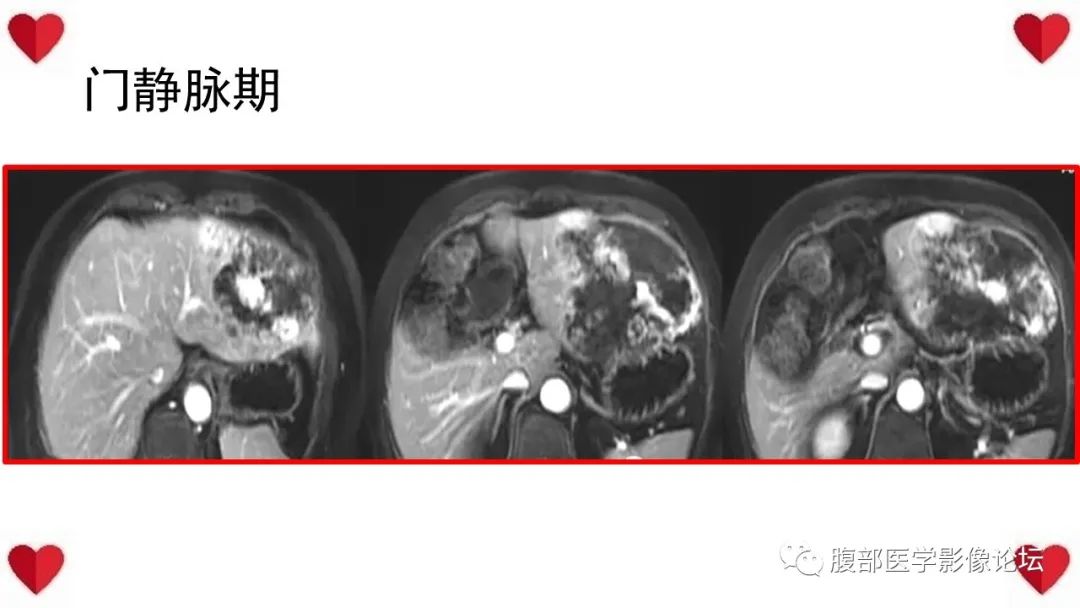影像PPT - 【病例】肝脏血管肉瘤1例CT及MR影像解析-12