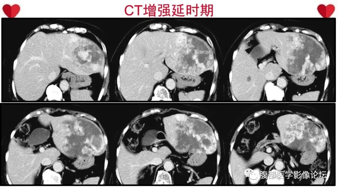 影像PPT - 【病例】肝脏血管肉瘤1例CT及MR影像解析-7