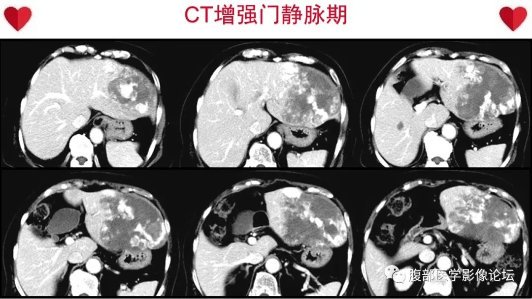 影像PPT - 【病例】肝脏血管肉瘤1例CT及MR影像解析-1