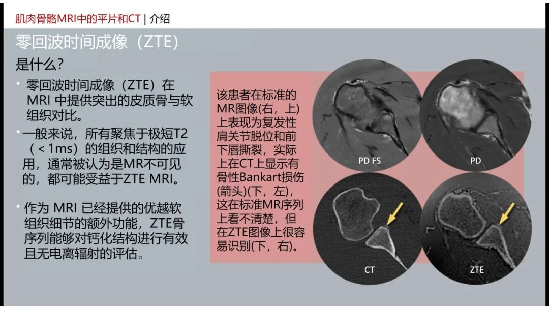 影像PPT - 【PPT】肌肉骨骼MRI中的平片和CT——零回波时间（ZTE）成像的挑战、优化和应用-9