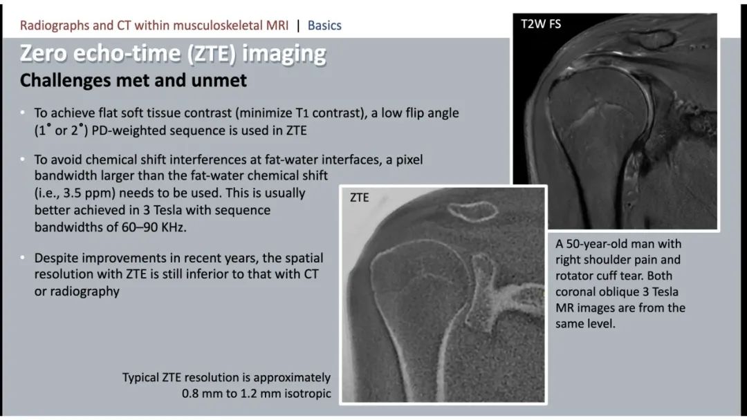 影像PPT - 【PPT】肌肉骨骼MRI中的平片和CT——零回波时间（ZTE）成像的挑战、优化和应用-16
