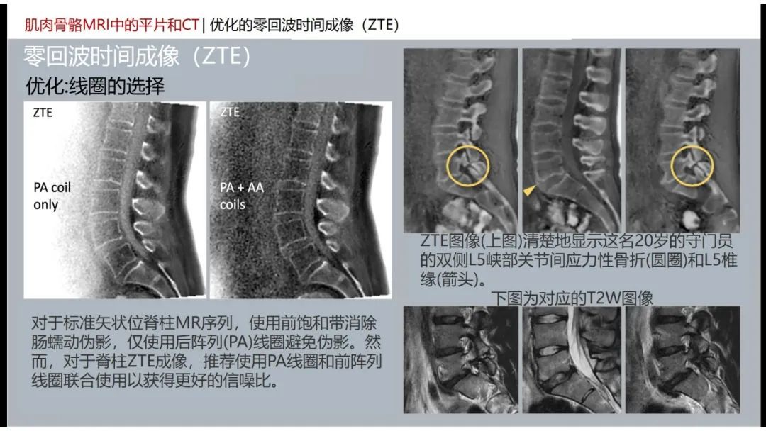 影像PPT - 【PPT】肌肉骨骼MRI中的平片和CT——零回波时间（ZTE）成像的挑战、优化和应用-19