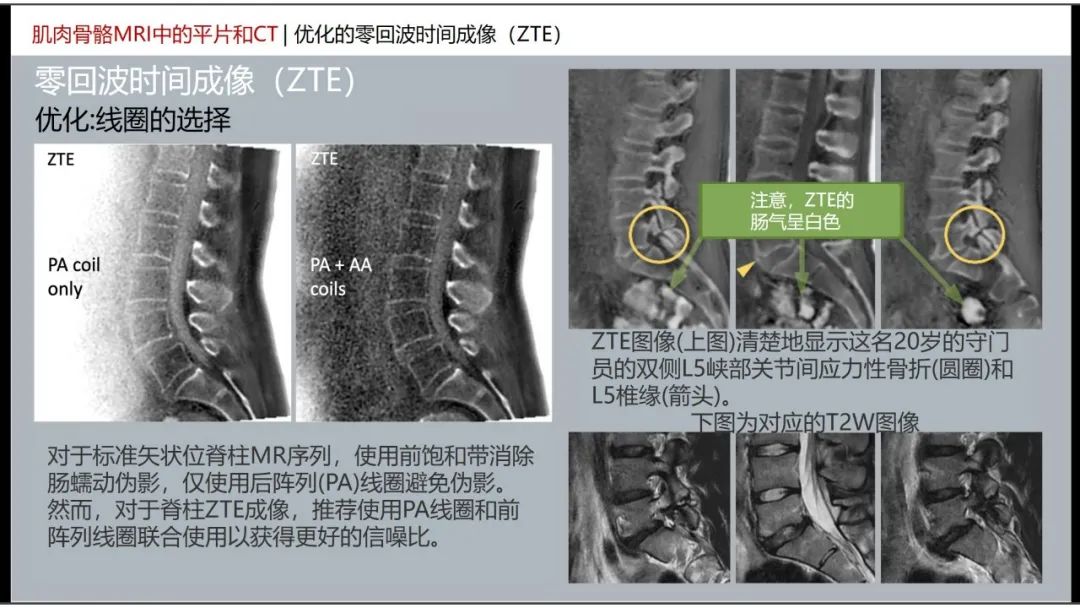 影像PPT - 【PPT】肌肉骨骼MRI中的平片和CT——零回波时间（ZTE）成像的挑战、优化和应用-21