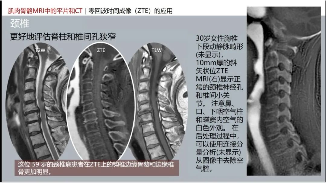 影像PPT - 【PPT】肌肉骨骼MRI中的平片和CT——零回波时间（ZTE）成像的挑战、优化和应用-23