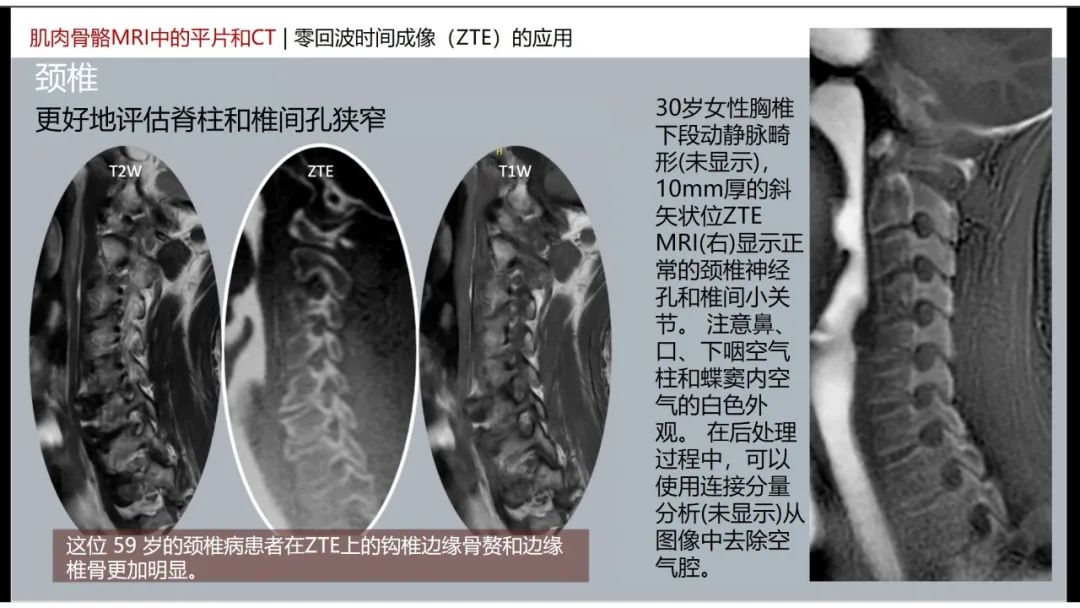 影像PPT - 【PPT】肌肉骨骼MRI中的平片和CT——零回波时间（ZTE）成像的挑战、优化和应用-25