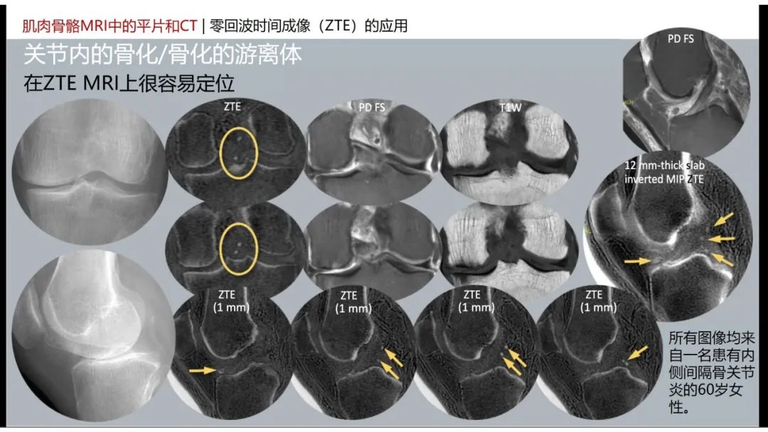 影像PPT - 【PPT】肌肉骨骼MRI中的平片和CT——零回波时间（ZTE）成像的挑战、优化和应用-27