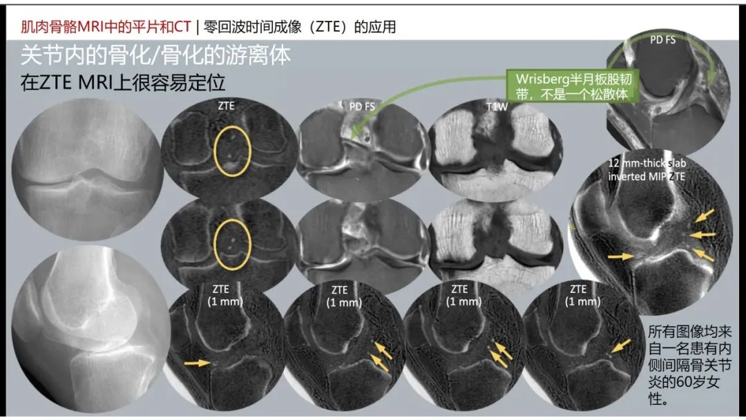 影像PPT - 【PPT】肌肉骨骼MRI中的平片和CT——零回波时间（ZTE）成像的挑战、优化和应用-29