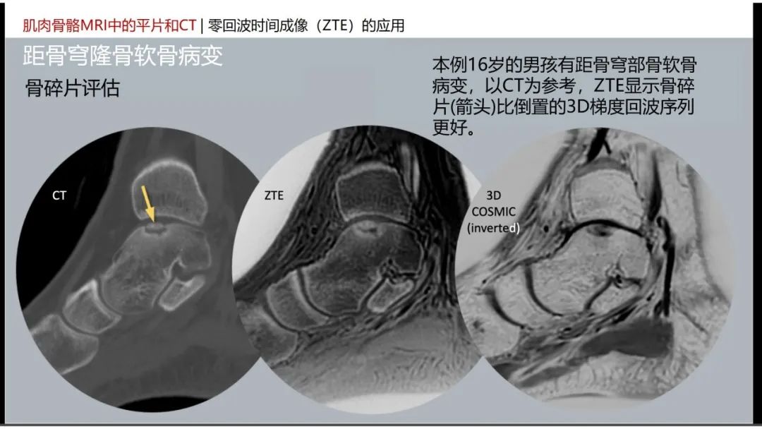 影像PPT - 【PPT】肌肉骨骼MRI中的平片和CT——零回波时间（ZTE）成像的挑战、优化和应用-31
